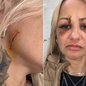 A cabeleireira Sharoh Daniel Lopparelli, de 45 anos, levou cerca de 20 pontos no rosto após ser atingida por uma taça de vidro na saída de um bar em Praia Grande. - Imagem: Reprodução /  Arquivo Pessoal