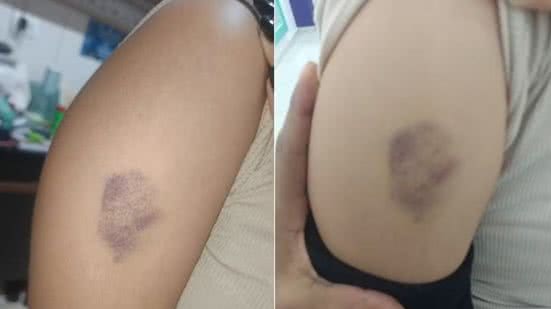 Estudante de 11 anos relatou ter sido agredida por um colega dentro de uma sala de aula em escola municipal de Praia Grande; caso é apurado pela Polícia Civil e também será analisado pelo conselho escolar - Imagem: Arquivo Pessoal