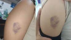 Estudante de 11 anos relatou ter sido agredida por um colega dentro de uma sala de aula em escola municipal de Praia Grande; caso é apurado pela Polícia Civil e também será analisado pelo conselho escolar - Imagem: Arquivo Pessoal