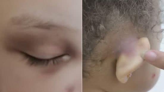 Menina de 2 anos apresentou hematomas após permanecer em creche municipal de Praia Grande; família cobra esclarecimentos sobre o caso - Imagem: Arquivo Pessoal