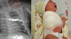 Bebê tem clavícula fraturada durante parto e mãe é denunciada ao Conselho Tutelar; entenda - Imagem: Reprodução | Acervo g1