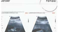 Defesa do médico afirma que ultrassom é para saúde do bebê e que erro pode ocorrer por fatores técnicos - Imagem: Reprodução