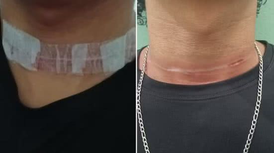 Pedro Henrique da Silva Vaz, de 19 anos, sofreu um corte no pescoço após ser atingido por uma linha de pipa enquanto pilotava uma motocicleta em Sete Barras - Imagem: Arquivo Pessoal
