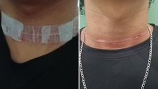 Pedro Henrique da Silva Vaz, de 19 anos, sofreu um corte no pescoço após ser atingido por uma linha de pipa enquanto pilotava uma motocicleta em Sete Barras - Imagem: Arquivo Pessoal
