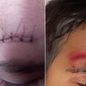 Menino de 6 anos sofreu um corte profundo na testa após incidente ocorrido dentro do banheiro de uma escola municipal de Registro e precisou receber atendimento médico - Imagem: Arquivo Pessoal