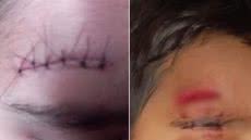Menino de 6 anos sofreu um corte profundo na testa após incidente ocorrido dentro do banheiro de uma escola municipal de Registro e precisou receber atendimento médico - Imagem: Arquivo Pessoal