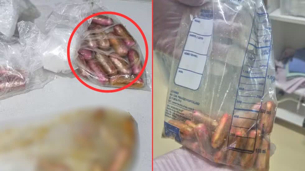 Um exame de raio-X revela 58 cápsulas no intestino de um boliviano, levando à sua prisão por tráfico de drogas em Guarujá - Foto: Divulgação/ Polícia Civil