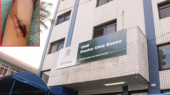 Menino de 7 anos, diagnosticado com Transtorno do Espectro Autista (TEA), recebeu 13 pontos no braço após acidente dentro de escola municipal de Santos; caso é acompanhado pela Prefeitura e investigado pela Polícia Civil - Imagem: Arquivo pessoal e Prefeitura de Santos