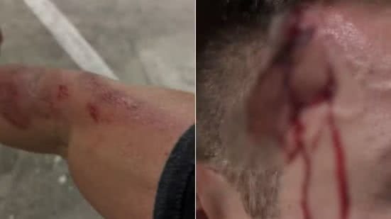 Guarda-vidas ficou ferido após cair da bicicleta ao tentar fugir de criminosos durante assalto em Guarujá - Imagem: Arquivo pessoal