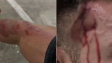Guarda-vidas ficou ferido após cair da bicicleta ao tentar fugir de criminosos durante assalto em Guarujá - Imagem: Arquivo pessoal