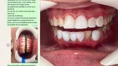 Foto mostra os dentes de adolescente durante a remoção das lentes colocadas por mulher que não é dentista - Imagem: Reprodução | Acervo