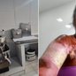 Restaurante Lisboa Antiga de Santos foi condenado após ex-ajudante de cozinha sofrer queimaduras de primeiro e segundo graus enquanto fritava batatas; valor total devido ainda será calculado pela Justiça. - Imagem: Reprodução