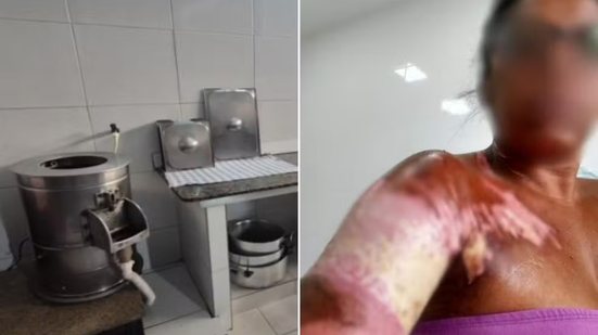 Restaurante Lisboa Antiga de Santos foi condenado após ex-ajudante de cozinha sofrer queimaduras de primeiro e segundo graus enquanto fritava batatas; valor total devido ainda será calculado pela Justiça. - Imagem: Reprodução