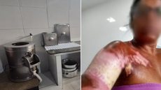 Restaurante Lisboa Antiga de Santos foi condenado após ex-ajudante de cozinha sofrer queimaduras de primeiro e segundo graus enquanto fritava batatas; valor total devido ainda será calculado pela Justiça. - Imagem: Reprodução