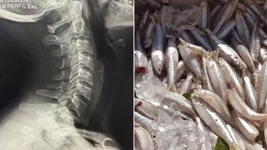 Influenciadora de 38 anos procurou atendimento em Santos após uma espinha de manjuba ficar presa na garganta durante uma refeição - Imagem: g1 Santos e divulgação/PM Ambiental