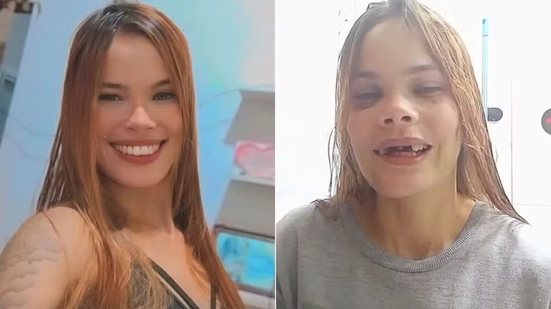 Gabriela Santana Gomes da Silva busca arrecadar recursos para realizar uma prótese dentária após perder cinco dentes em um acidente de motocicleta ocorrido em maio, em Praia Grande - Imagem: Reprodução/Redes sociais