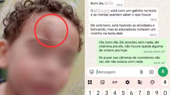 Mãe denuncia creche municipal de Praia Grande após filho de dois anos voltar para casa com hematoma no rosto. Família relata episódios anteriores de mordidas e cobra esclarecimentos sobre o ocorrido. - Arquivo Pessoal
