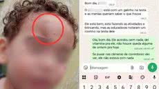 Mãe denuncia creche municipal de Praia Grande após filho de dois anos voltar para casa com hematoma no rosto. Família relata episódios anteriores de mordidas e cobra esclarecimentos sobre o ocorrido. - Arquivo Pessoal