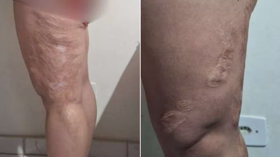 Tribunal de Justiça de São Paulo aumentou para R$ 150 mil a indenização devida a uma ex-aluna que sofreu queimaduras com ácido sulfúrico em escola estadual de Praia Grande, em 2017 - Imagem: Reprodução