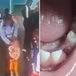 Criança de 3 anos perdeu um dente após se ferir no refeitório de uma escola municipal de Peruíbe; família questiona a conduta de uma professora e o caso é apurado pelas autoridades - Imagem: Reprodução