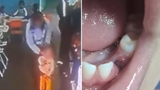 Criança de 3 anos perdeu um dente após se ferir no refeitório de uma escola municipal de Peruíbe; família questiona a conduta de uma professora e o caso é apurado pelas autoridades - Imagem: Reprodução