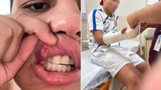 Jovem apresenta marcas após relatar agressão ocorrida em frente a unidade do McDonald's em Praia Grande - Imagem: Arquivo Pessoal