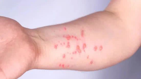 Laudos negativos para mpox descartam dois casos suspeitos em Mongaguá, que permanece sem registros da doença - Imagem: Reprodução/Ministério da Saúde