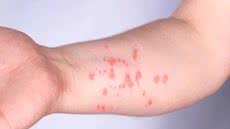 Laudos negativos para mpox descartam dois casos suspeitos em Mongaguá, que permanece sem registros da doença - Imagem: Reprodução/Ministério da Saúde