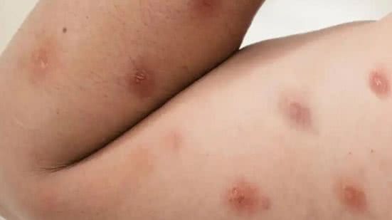 Febre, ínguas e lesões na pele estão entre os principais sintomas da Mpox; transmissão ocorre por contato direto com infectados ou materiais contaminados - Imagem: Reprodução/Freepik