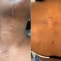Mulher atacada com mais de 20 golpes de faca pelo ex-companheiro, em março de 2025, ficou com cicatrizes e outras sequelas. Lucas Lopes da Silva foi condenado a 37 anos e quatro meses de prisão por tentativa de feminicídio - Imagem: Arquivo Pessoal
