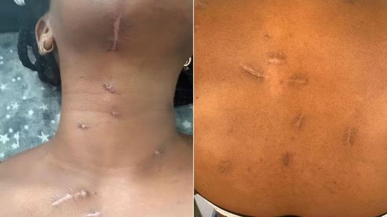 Mulher atacada com mais de 20 golpes de faca pelo ex-companheiro, em março de 2025, ficou com cicatrizes e outras sequelas. Lucas Lopes da Silva foi condenado a 37 anos e quatro meses de prisão por tentativa de feminicídio - Imagem: Arquivo Pessoal