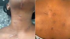Mulher atacada com mais de 20 golpes de faca pelo ex-companheiro, em março de 2025, ficou com cicatrizes e outras sequelas. Lucas Lopes da Silva foi condenado a 37 anos e quatro meses de prisão por tentativa de feminicídio - Imagem: Arquivo Pessoal